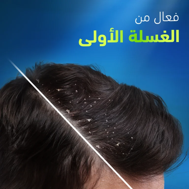 ⁦شامبو هيد آند شولدرز لفروة الرأس شديدة الدهنية 400 مل⁩ - الصورة ⁦5⁩
