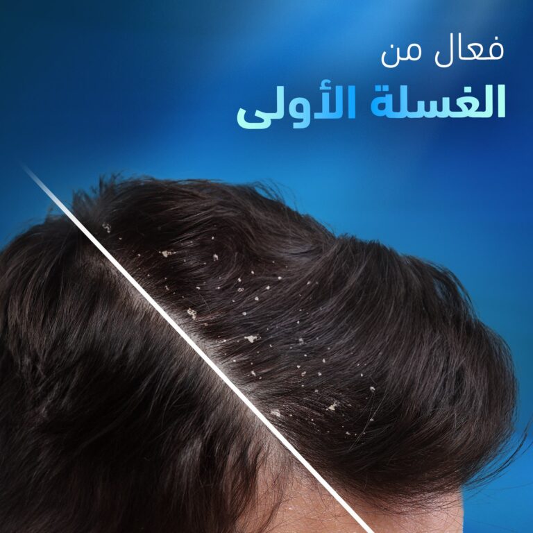 ⁦شامبو هيد آند شولدرز لفروة الرأس شديدة القشرة 400 مل⁩ - الصورة ⁦5⁩