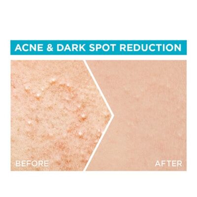 Garnier Skinactive Fast Clear Booster Serum with Salicylic Acid 30 ml