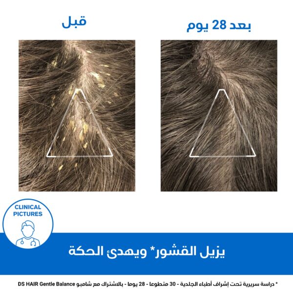 ⁦يورياج دي اس شامبو لعلاج قشرة الرأس الشديدة مع حمض اللاكتيك | خالٍ من الصابون 150 مل⁩ - الصورة ⁦4⁩